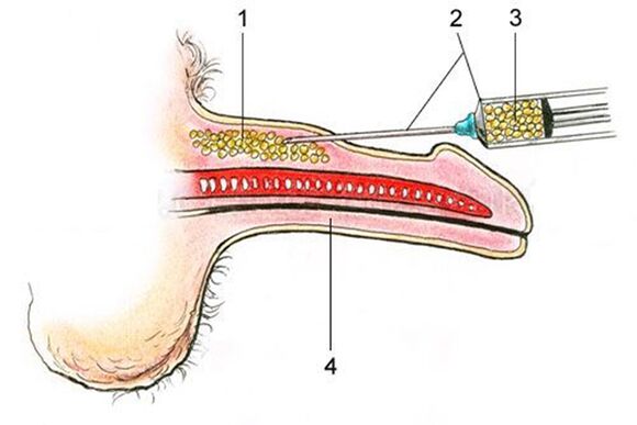 Lipofilling - vnos maščobnega tkiva v steblo penisa
