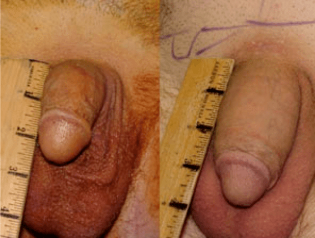 Pred in po lipofilingu in implantaciji gela