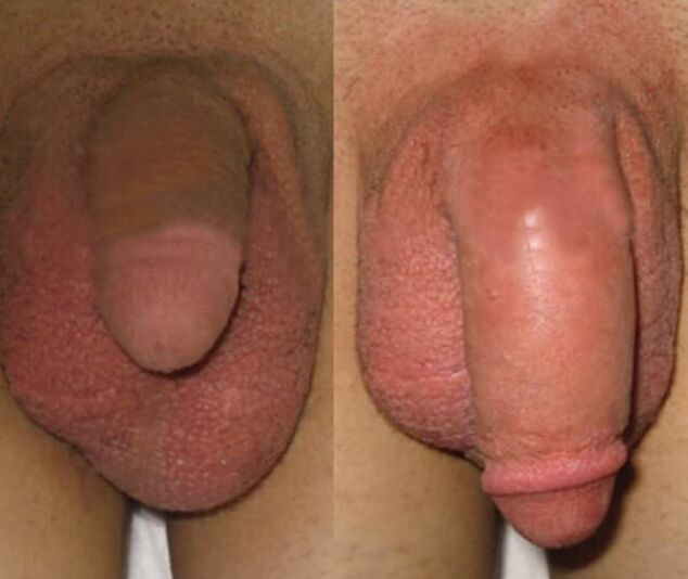 Rezultat vgradnje kolagenske matrice v penis